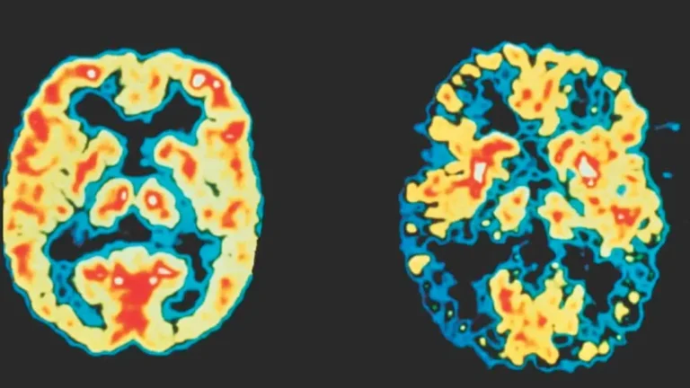 ارتفاع مستويات جزيئات البلاستيك في دماغ مرضى الخرف بمعدل خمسة أضعاف