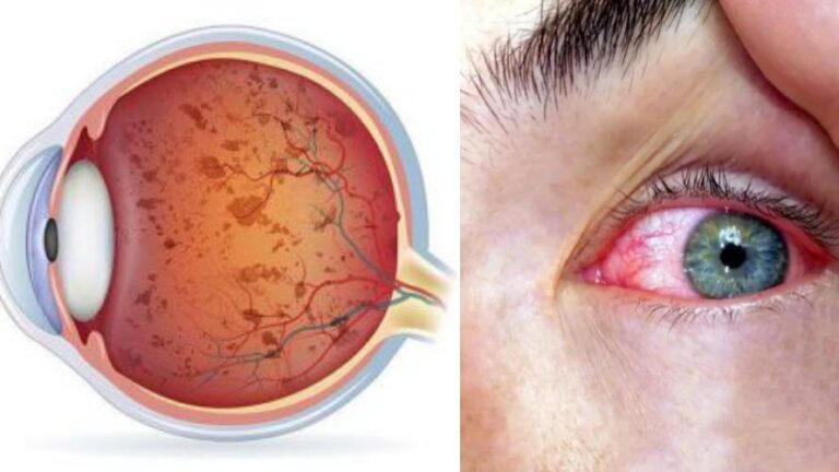 التهاب الشبكية الصباغي يتحول من ضعف النظر ليلاً إلى تهديد حقيقي للبصر