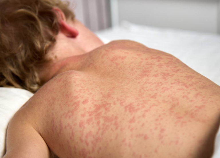 تفشي الحصبة يصيب 80 طفلًا في شمال لندن بسبب تراجع معدلات التطعيم