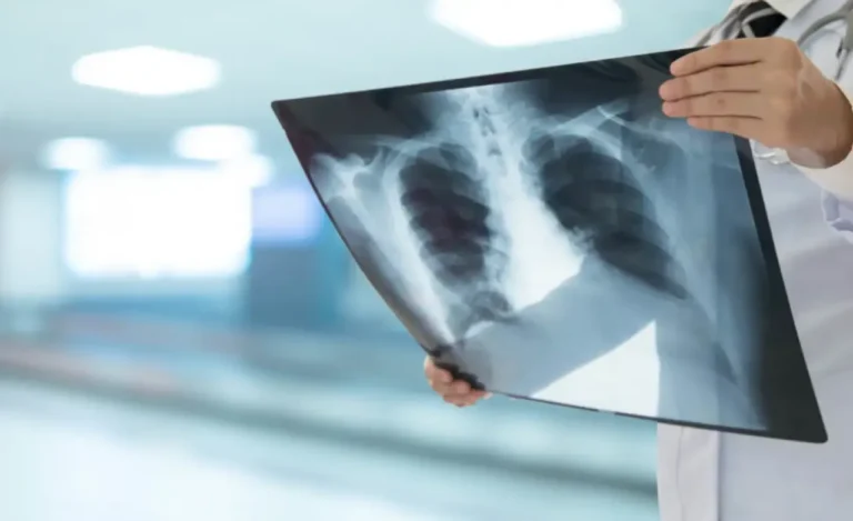 تحذيرات جديدة لمتعافي كوفيد-19 حول مخاطر الإصابة بسرطان الرئة