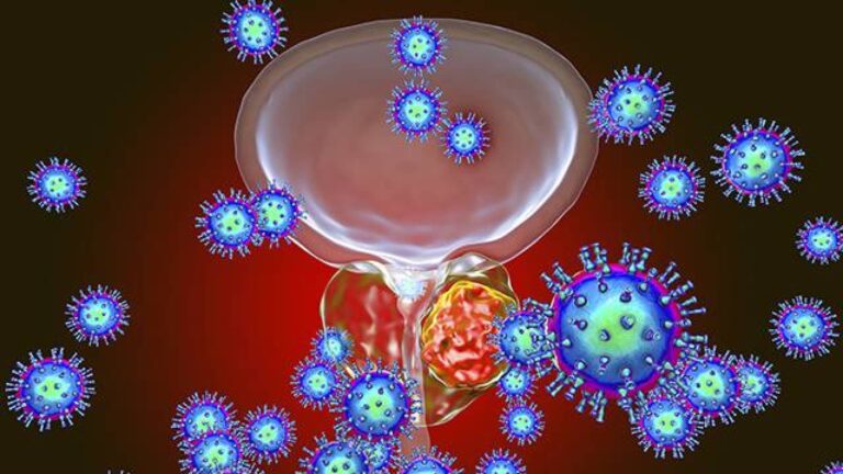 انخفاض هرمون التستوستيرون يرتبط بزيادة خطر الإصابة بسرطان البروستاتا