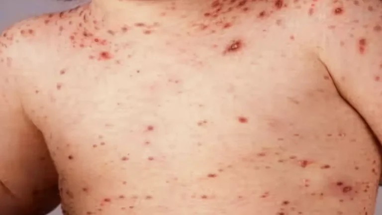 اليمن تواجه أزمة حصبة حادة مع تسجيل 23 ألف حالة و214 وفاة والأرقام الحقيقية أعلى بكثير